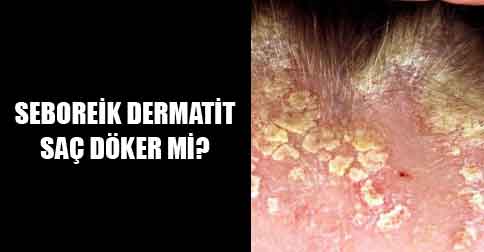 seboreik-dermatit-sac-dokermi